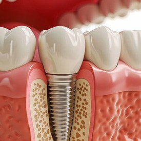 a 3D illustration of a dental implant undergoing osseointegration