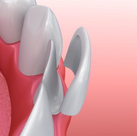 Illustration of veneer being placed on bottom tooth